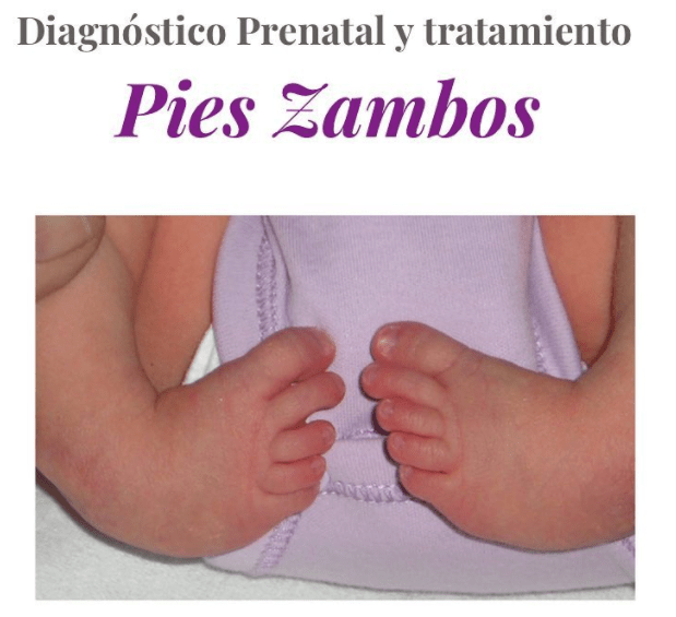 pies zambos bebe